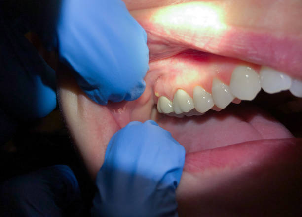 Best Emergency Wisdom Tooth Extraction in Cumberland, KY